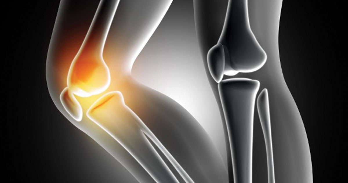 Total Knee Replacement